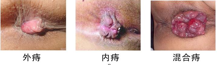 痔疮2.jpg